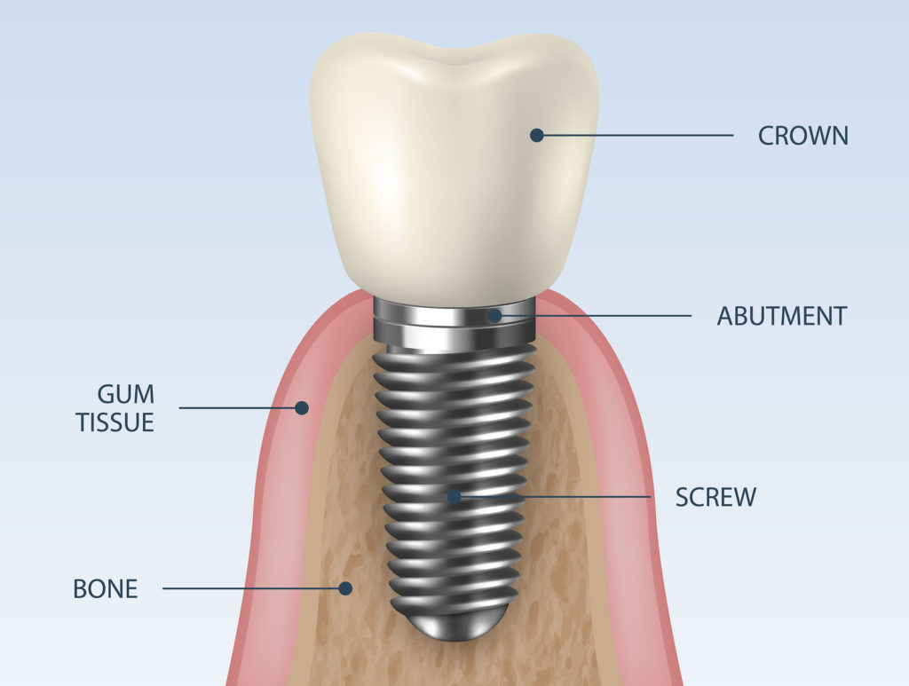 اجزای دندان ایمپلنت شده